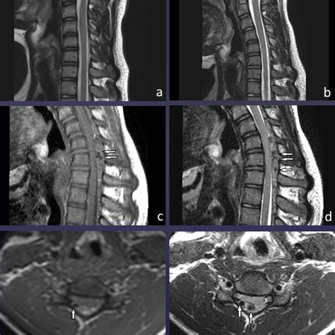 Hirayama Disease Normal Mri Finding On Sagittal T2 Weighted Images In