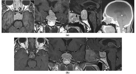 A 49 Year Old Male Patient With Giant Pituitary Adenoma And Conical