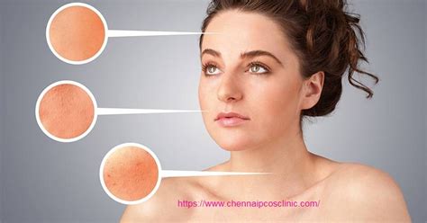 PCOS and Acne - PCOS Treatment in Chennai | PCOS hospital Chennai