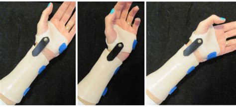 Splint In The Spotlight Orthoses To Prevent Full Forearm Rotation