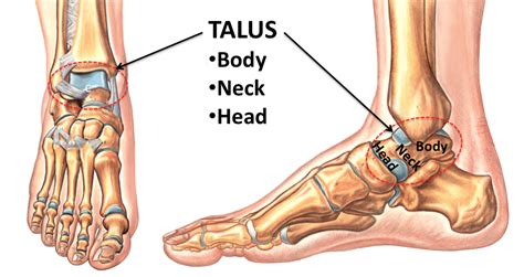 Talar Body Fracture Footeducation