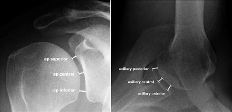 True A Anteroposterior And B Axillary View Radiographs Of The Right