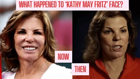 Taylor Fritz Mother Kathy May Fritz Face Surgery Disaster!