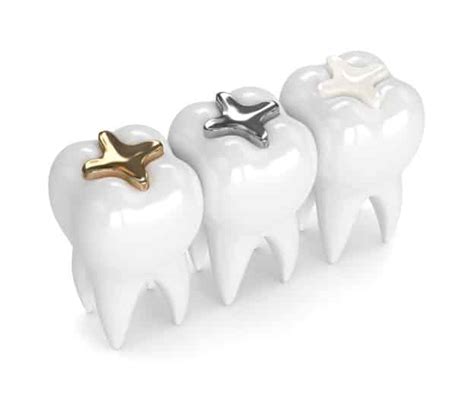 What Are the Types of Dental Fillings? - Mile High Dental Centers