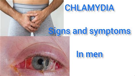 5 Signs And Symptoms Of Chlamydia In Men YouTube