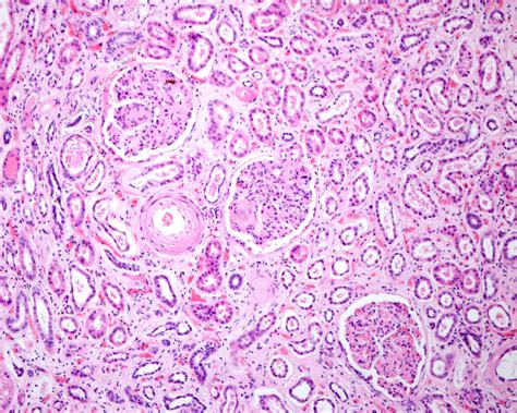 Diabetic Nephropathy Light Micrograph Stock Image C