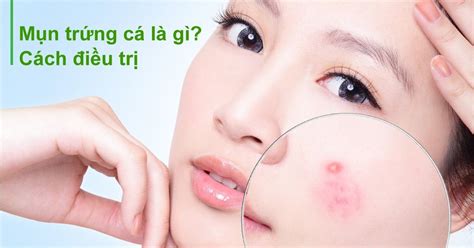 Mụn Trứng Cá Là Gì Cách điều Trị