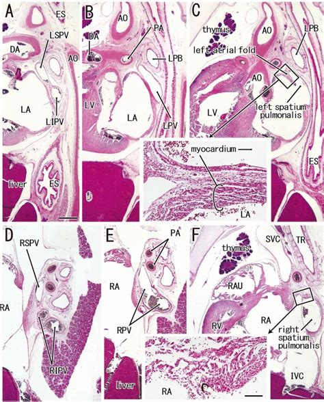 The So Called Absorption Process Of The Pulmonary Vein Into The Left