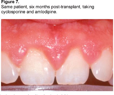 Figure 1 From Treating Patients With Drug Induced Gingival Overgrowth