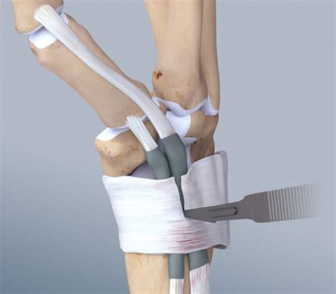 Décompression de la ténosynovite de Quervain Hand Surgeon Montreal