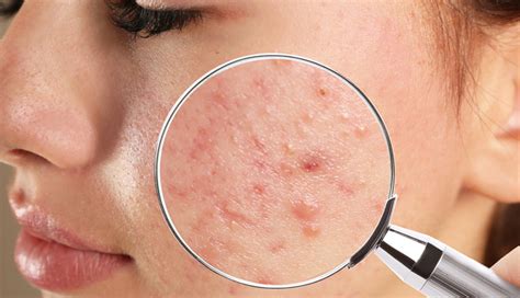 7 Remedies To Get Rid Of Acne Scars Naturally At Home