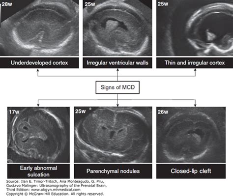 Malformations Of Cortical Development Radiology Key