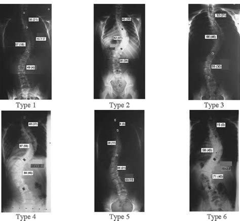 The Lenke Classification System For Adolescent Idiopathic Scoliosis Neupsy Key