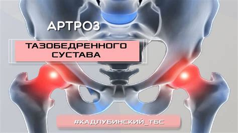 Артроз тазобедренного сустава - YouTube