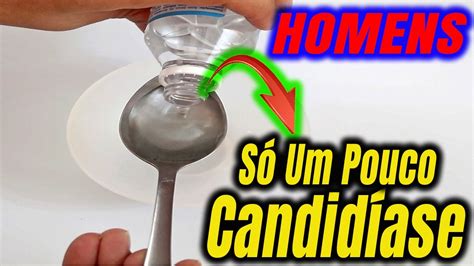 Candid Ase Masculina Receita R Pida Para Tratamento Eficaz Youtube