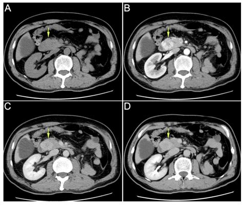 Ampulla Of Vater Cancer Hot Sex Picture