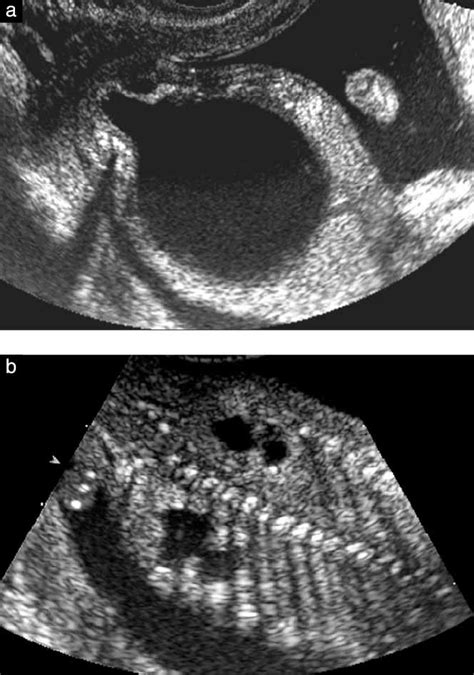 Successful Vesicoamniotic Shunting Of Posterior Urethral Valves In The First Trimester Of