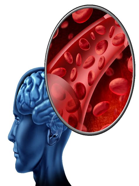 Ischemic Stroke Treatment | MIMS Malaysia