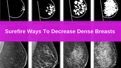 The Most Surefire Ways To Decrease Dense Breasts Breast Cancer Conqueror