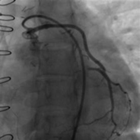 Cardiac Paraganglioma Advantages Of Cardiovascular Multimodality