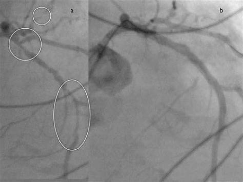 Case 5 Cranial RAO 40 10 View Of LCA Before And After Distal