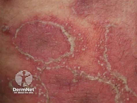 Definitions And Diagnostic Criteria Of Generalized Pustular Psoriasis