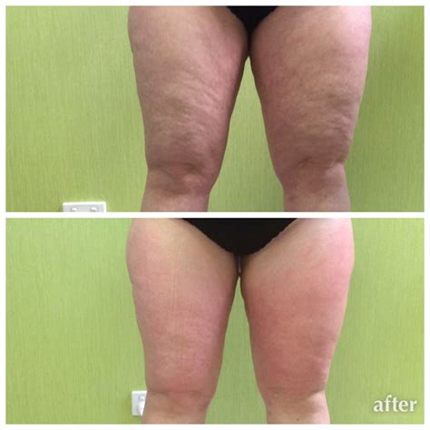 Velashape Before And After Thighs