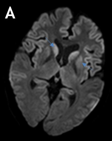 A 45 Years Old Female Patient Presented With Complaints Of Insomnia Impaired Memory Behavior