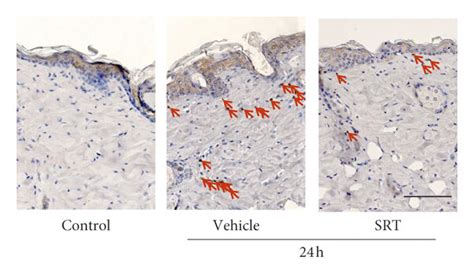 Effect Of Srt On Uvb Induced Inflammatory Cell Infiltration And