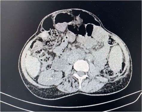 Frontiers Publishing Partnerships Case Report Abdominal Wall