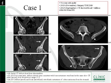 Figure 2 From Osteosclerotic Bone Metastases From Gastric