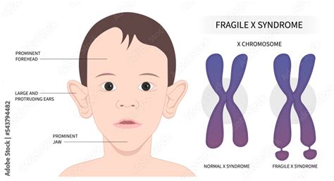 Fragile X Ears