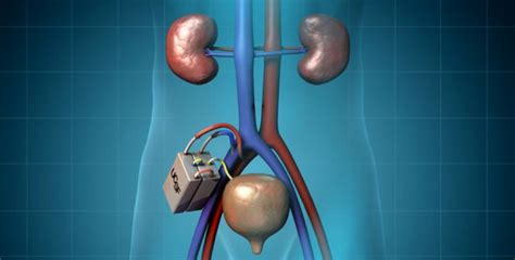 Coming Soon An Artificial Kidney For Patients With Renal Failure