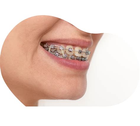 Orthodontie Mutualit Fran Aise Sa Ne Et Loire Dentiste Sa Ne Et Loire