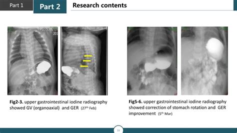 Ppt Preventative Effect Of Massage On Gastric Volvulus In Infants With Powerpoint Presentation