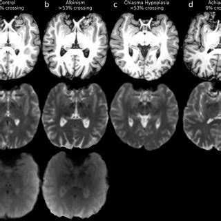 Overview of structural abnormalities of the optic chiasm and provided ...