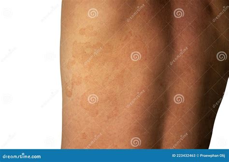 Tinea Versicolor Pityriasis Versicolor Skin Infection On The Back Is A