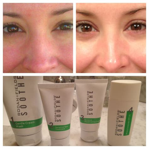 Goodbye Rosacea Rodan Fields Soothe Regimen Has Completely