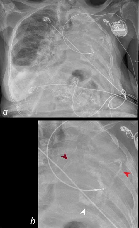 Faces of Calcification | Lungs