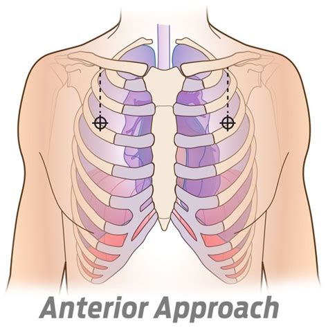 Needle Decompression Spear Simplified Pneumothorax Emergency Air