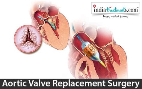 Aortic Valve Replacement Surgery - Indiatreatments.com