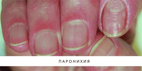 Лечение грибка ногтей в СПБ — клиника грибка ногтей