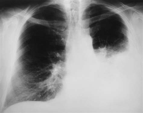 Pleuropulmonary Manifestations Of Systemic Lupus Erythematosus Thorax