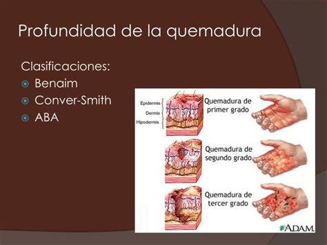 PPT Quemaduras PowerPoint Presentation ID 4229520