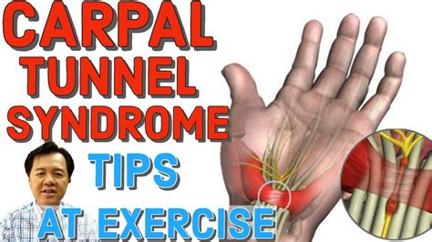 Carpal Tunnel Syndrome Tips At Exercise By Doc Willie Ong Youtube