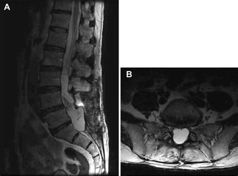 Postoperative Magnetic Resonance Imaging At 3 Months A The Arachnoid