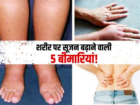 Swelling On Body Reason In Hindi शरीर में छिपी 5 गंभीर बीमारियों की वजह से आ जाती है शरीर पर