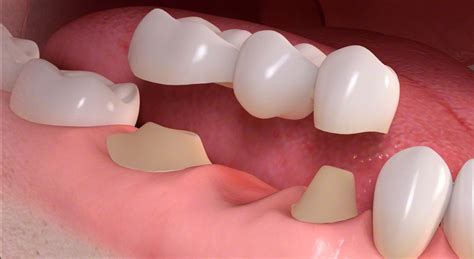 Dental Bridges A Complete Overview