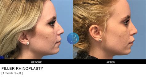 Filler Rhinoplasty 3 Jacob Bloom Md