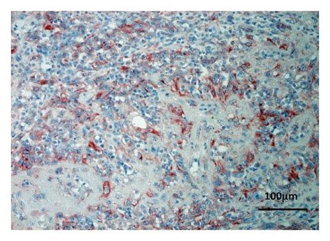 paraffin embedded tissue samples  patients  recurrent